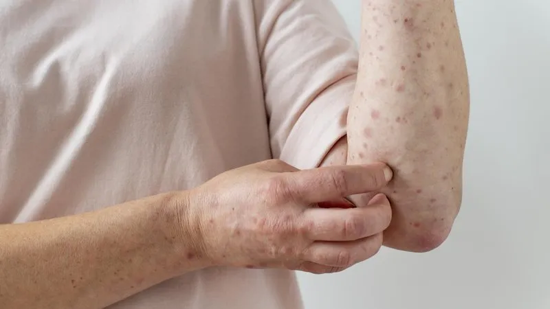 Brasil registra 149 casos de mpox em 2026; São Paulo concentra maioria das infecções